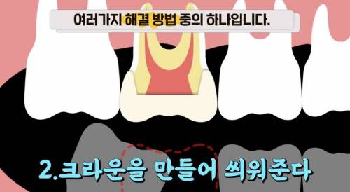 [스압] 빠진 치아 방치하면 생기는 일