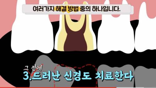 [스압] 빠진 치아 방치하면 생기는 일