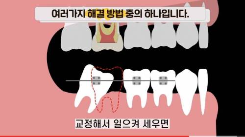 [스압] 빠진 치아 방치하면 생기는 일