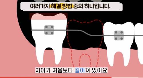 [스압] 빠진 치아 방치하면 생기는 일