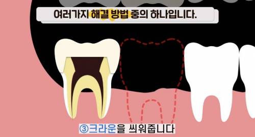 [스압] 빠진 치아 방치하면 생기는 일