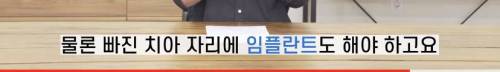 [스압] 빠진 치아 방치하면 생기는 일