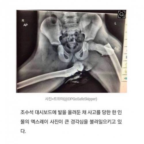 조수석 대시보드에 발을 올리면 안되는 이유.jpg