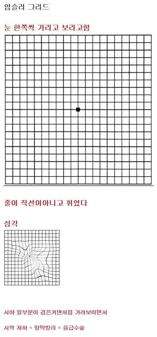 [스압] 방치하면 실명할 수 있는 눈 이상 증상...jpg