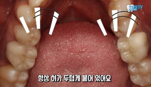 [스압] 양치할 때 놓치는 부위 TOP 5