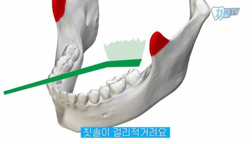 [스압] 양치할 때 놓치는 부위 TOP 5