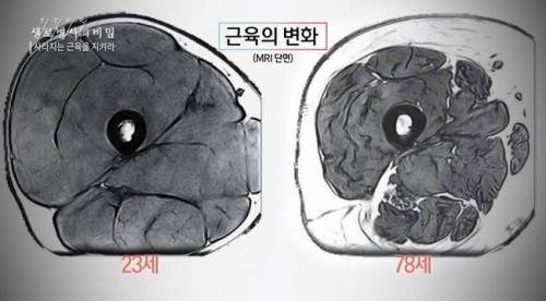 20대와 70대의 허벅지 단면 차이.jpg