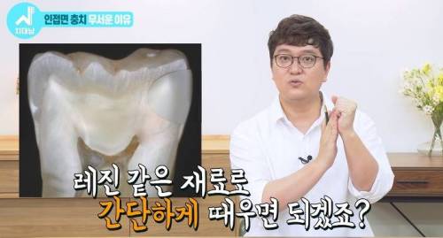 [스압] 치과의사들 "쓰읍" 소리나게 한다는 충치...jpg