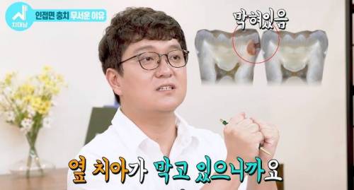 [스압] 치과의사들 "쓰읍" 소리나게 한다는 충치...jpg