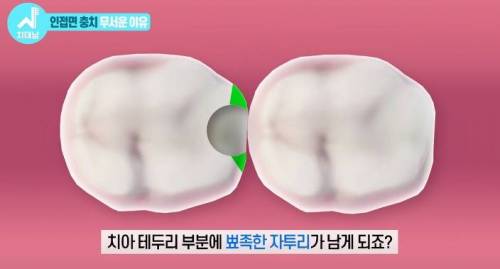 [스압] 치과의사들 "쓰읍" 소리나게 한다는 충치...jpg