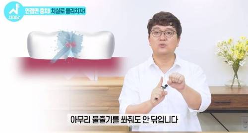 [스압] 치과의사들 "쓰읍" 소리나게 한다는 충치...jpg