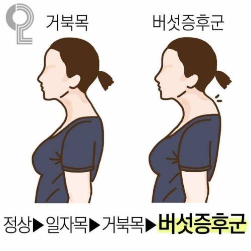 거북목보다 더 심하다는 버섯증후군