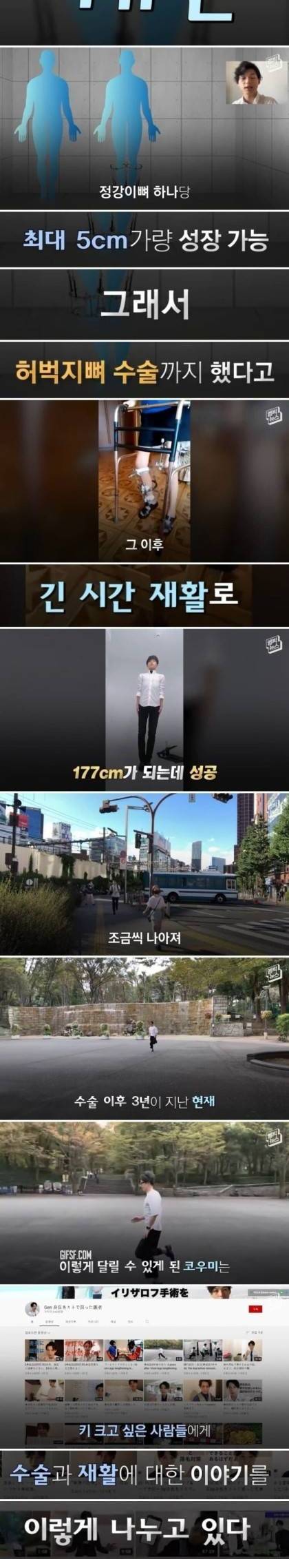 골연장 수술로 키를 10㎝ 키운 의사