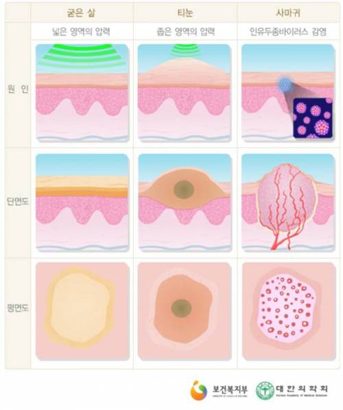 				티눈과 사마귀 구별하는 방법.jpg