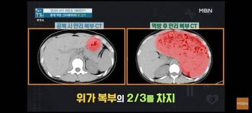 10인분이상 먹방후 먹방유투버의 위 상태