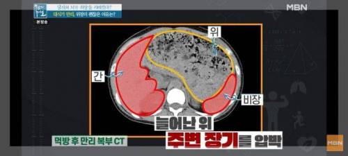 10인분이상 먹방후 먹방유투버의 위 상태