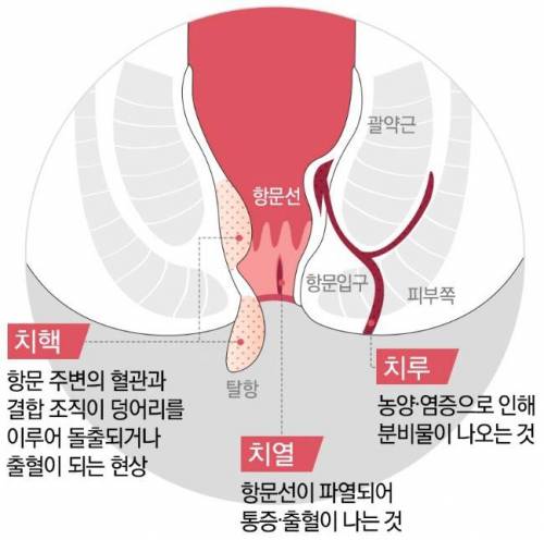 아파도 부끄러워서 병원 못 가는 질병 