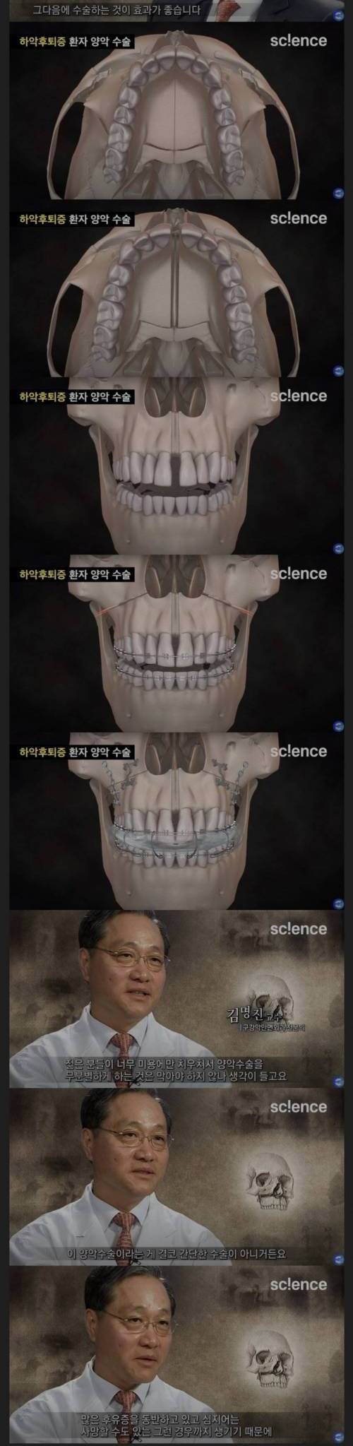 양악 수술의 위험성.jpg