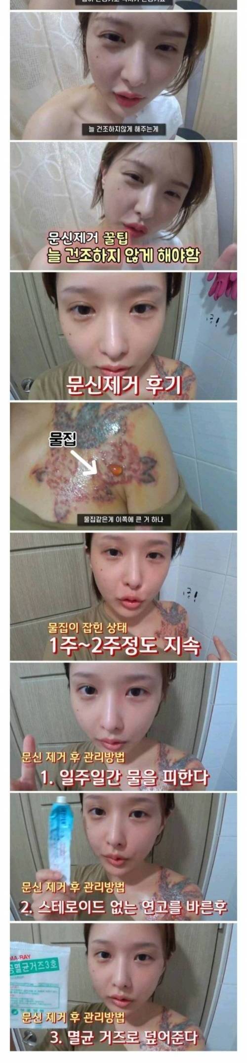 어느 유튜버의 타투제거 후기 .jpg