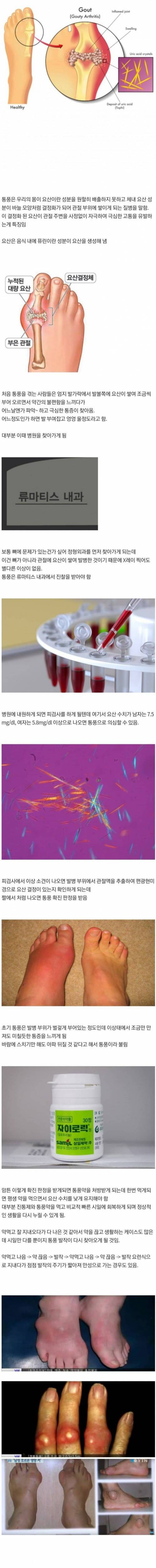 참을 수 없는 통풍의 고통.jpg