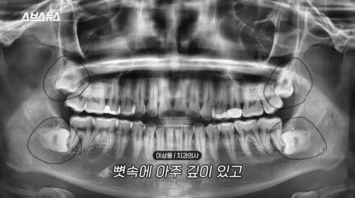 치과의사가 지금까지 일하면서 봐왔던 어려웠던 사랑니