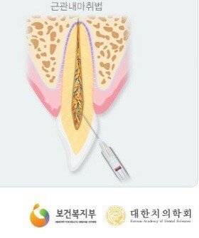 치과에서 가장 아프다는거.jpg