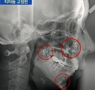 				양악수술 후 엑스레이