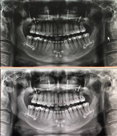 				양악수술 후 엑스레이