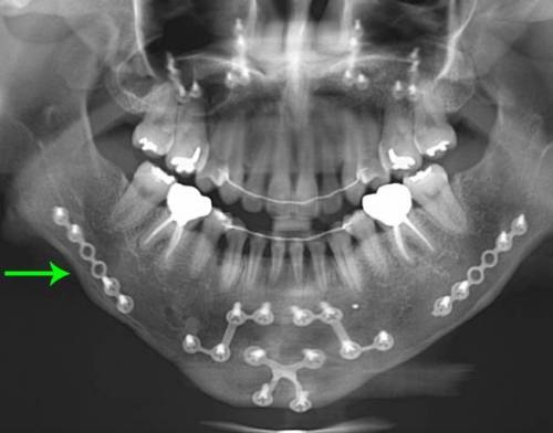 				양악수술 후 엑스레이