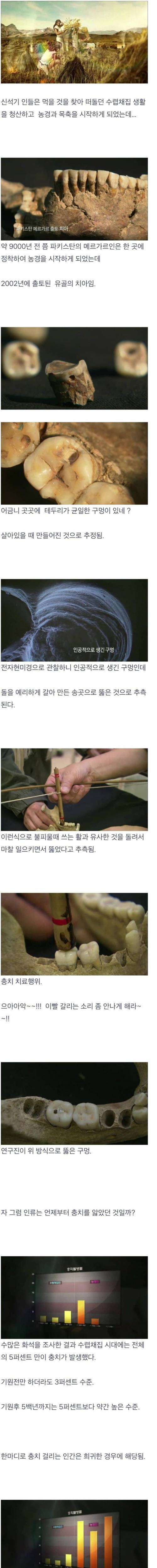 인간은 언제부터 충치가 생겼을까?