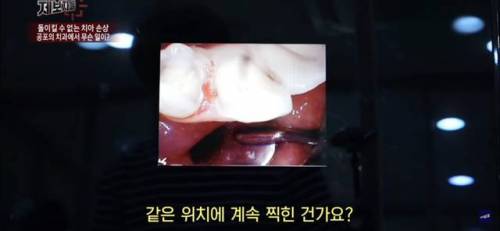 구강 카메라에 얼룩이 묻으면 충치처럼 보인다??