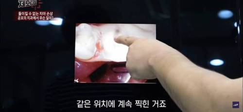 구강 카메라에 얼룩이 묻으면 충치처럼 보인다??