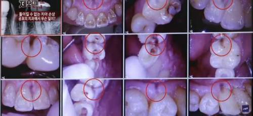 구강 카메라에 얼룩이 묻으면 충치처럼 보인다??
