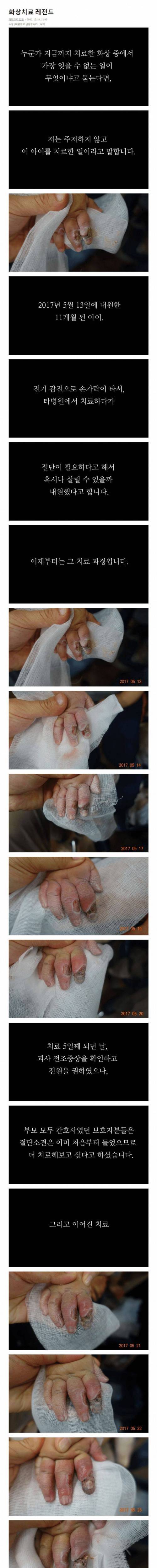[사진주의]한의학 화상치료 레전드