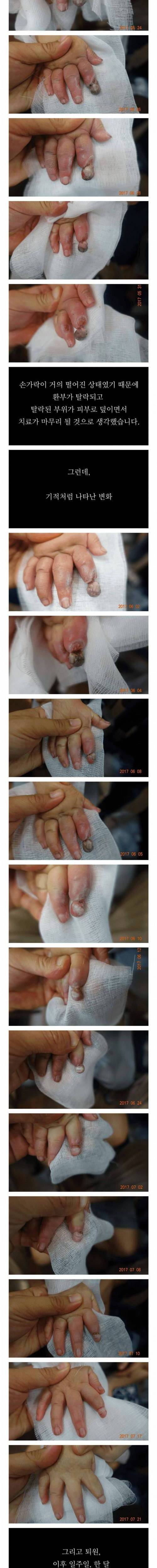 [사진주의]한의학 화상치료 레전드