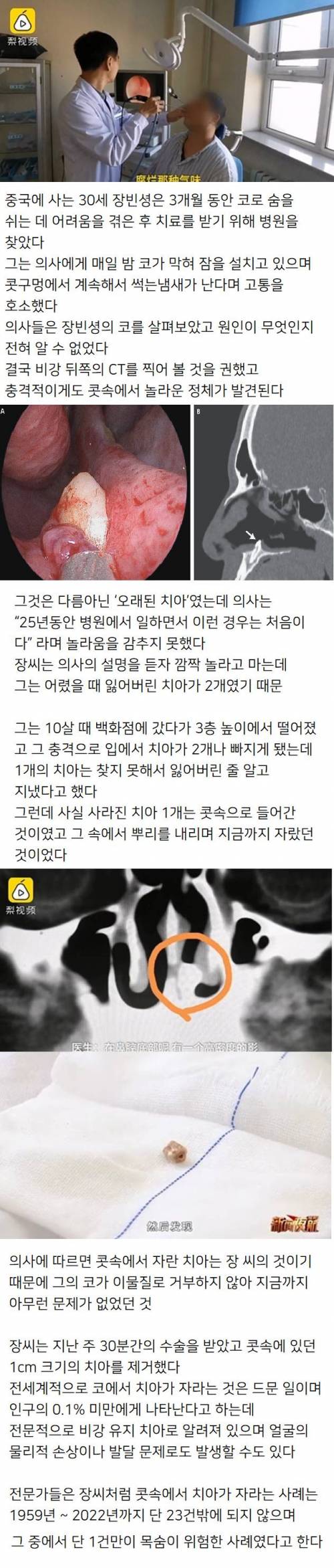 코에서 썩는 냄새가 나는 남성. JPG