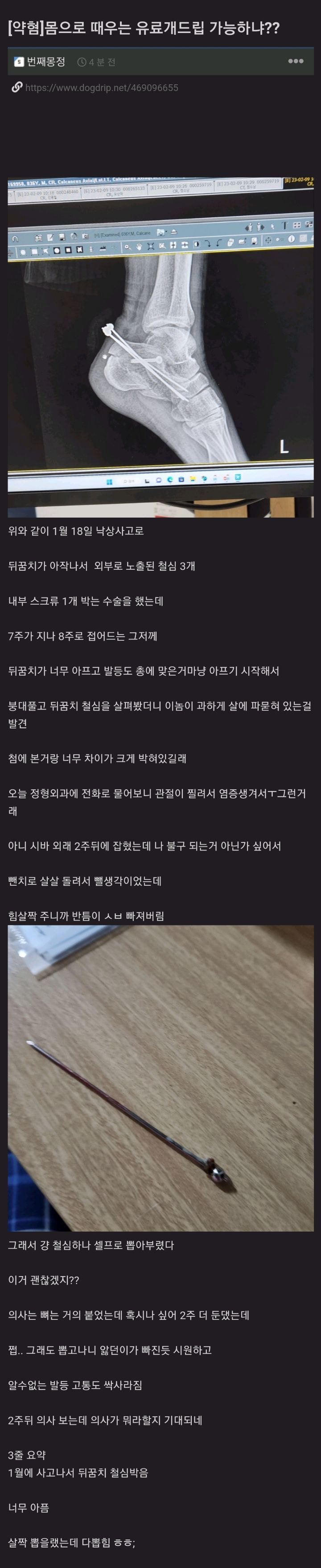 의사가 박아놓은 철심을 거슬린다고 방금 집에서 뺀치로 빼버린 사람