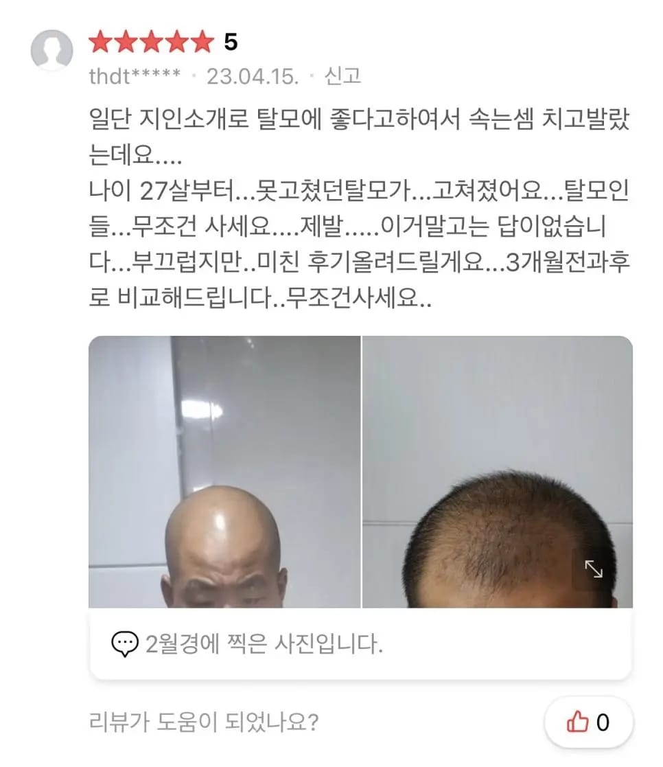 속눈썹 영양제로 풍성해진 탈모인