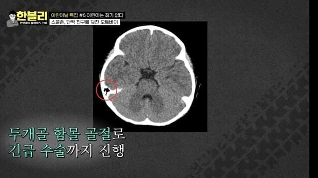 예전 한문철TV에 나왔던, 신호위반 오토바이에 치인 어린아이...