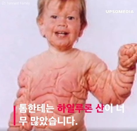 과잉 피부로 태어난 톰 테넌트의 이야기.jpg