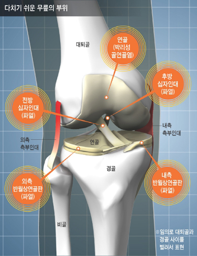 뼈 인대등 다쳐본 사람은 공감하는것.jpg