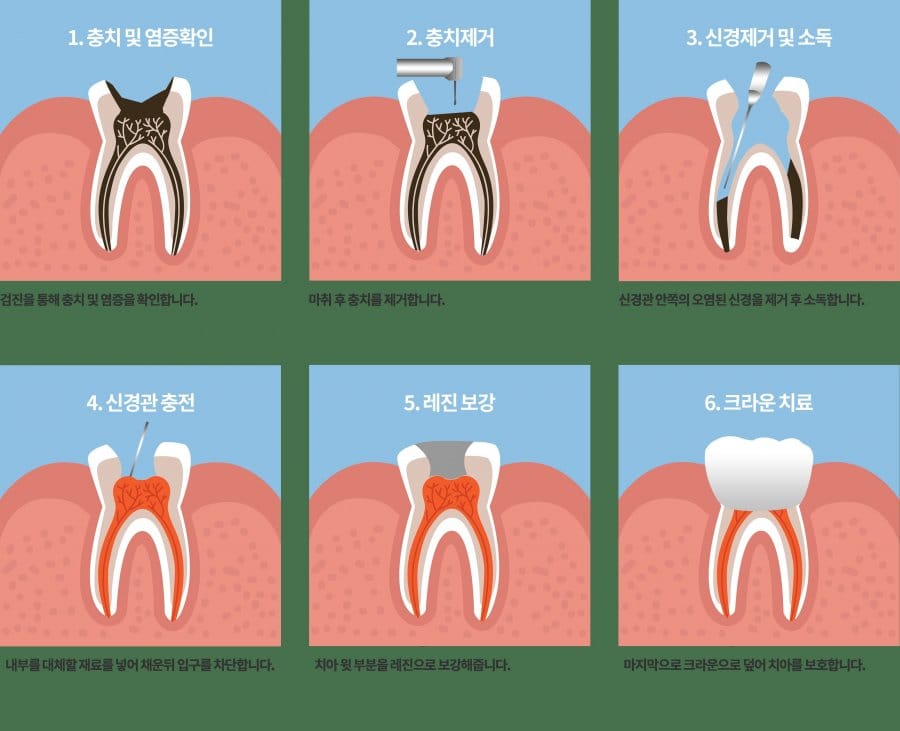치과 신경치료의 원리.mp4