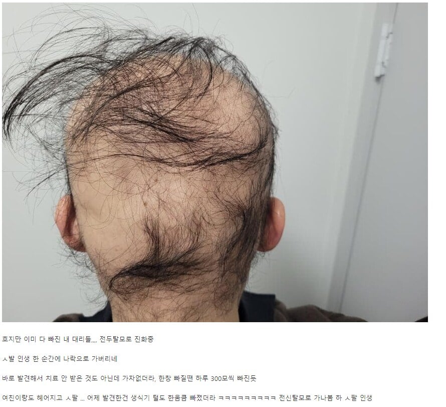 디시 탈모갤.... 레전드 사례...jpg