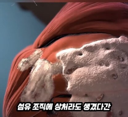 근육과 힘줄이 뼈로 변하는 질병