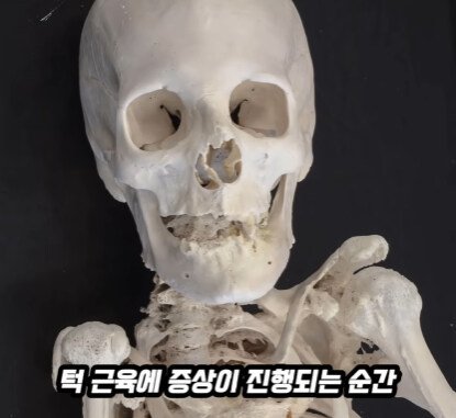 근육과 힘줄이 뼈로 변하는 질병