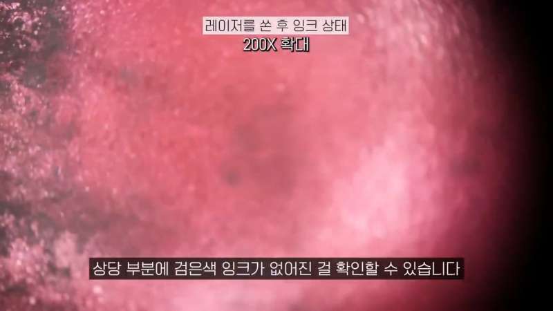 알리에서 파는 7만원 짜리 문신제거 레이저 후기