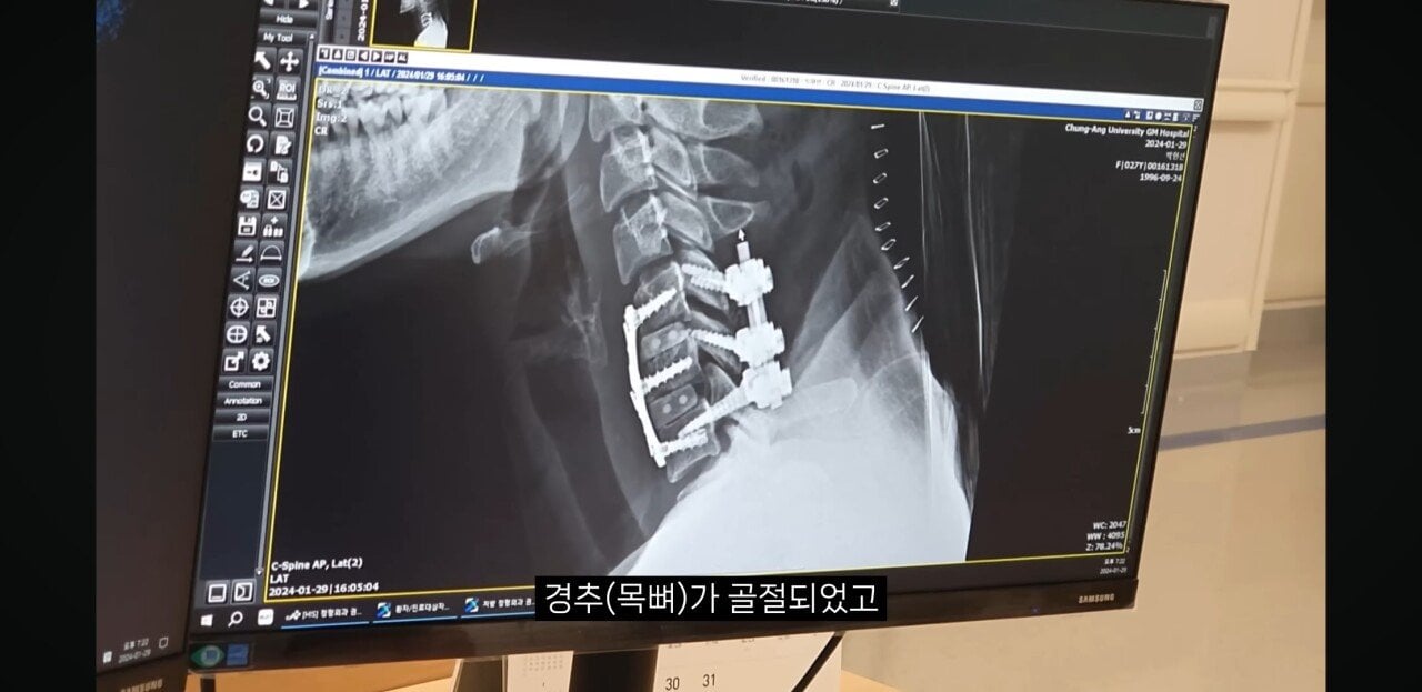 해외여행에서 단 1초만에 전신마비가 된 사람
