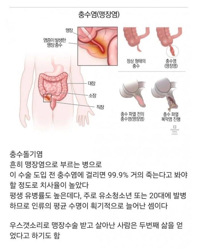 인류의 수명을 거의 두배로 늘려준 수술.jpg