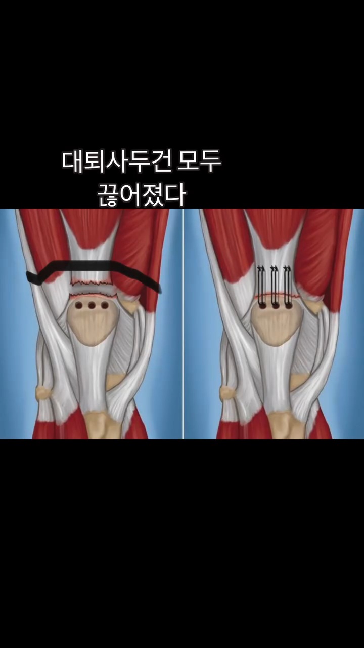 스쿼드 할때 조심해야 되는 이유.gif