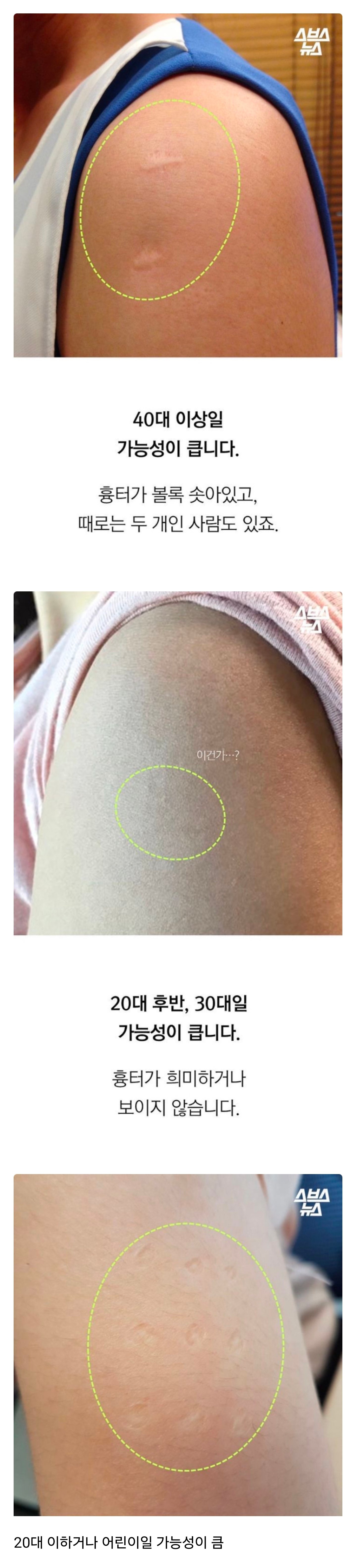 나이대로 다르다는 불주사 자국